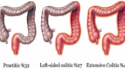 Монреальская классификация язвенного колита по протяженности поражения